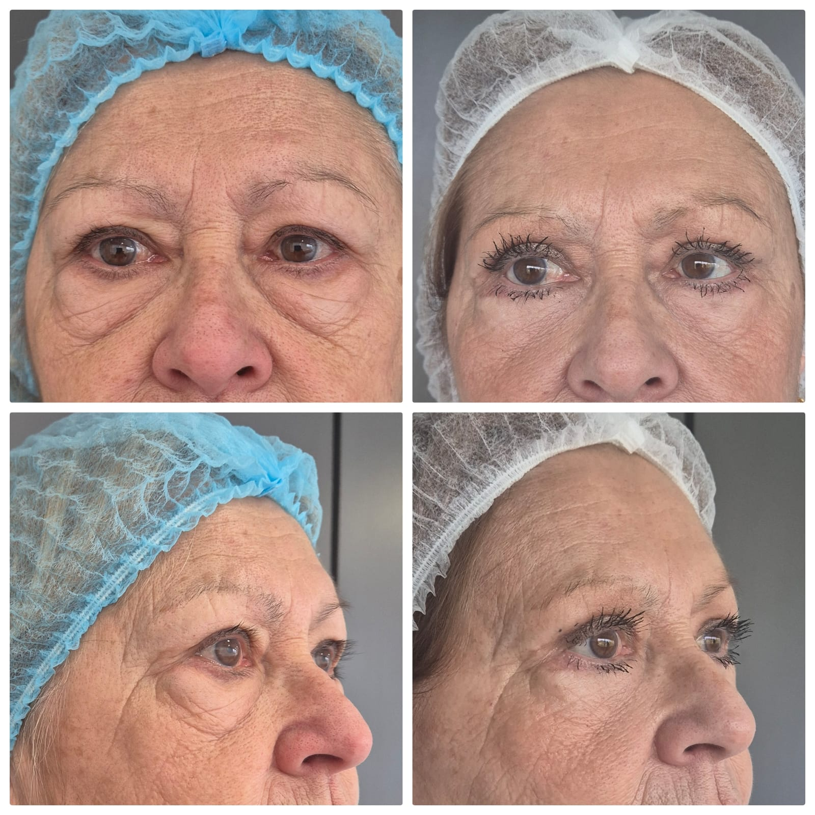 Blefaroplastía Simple — Antes y después de paciente BioSurgery