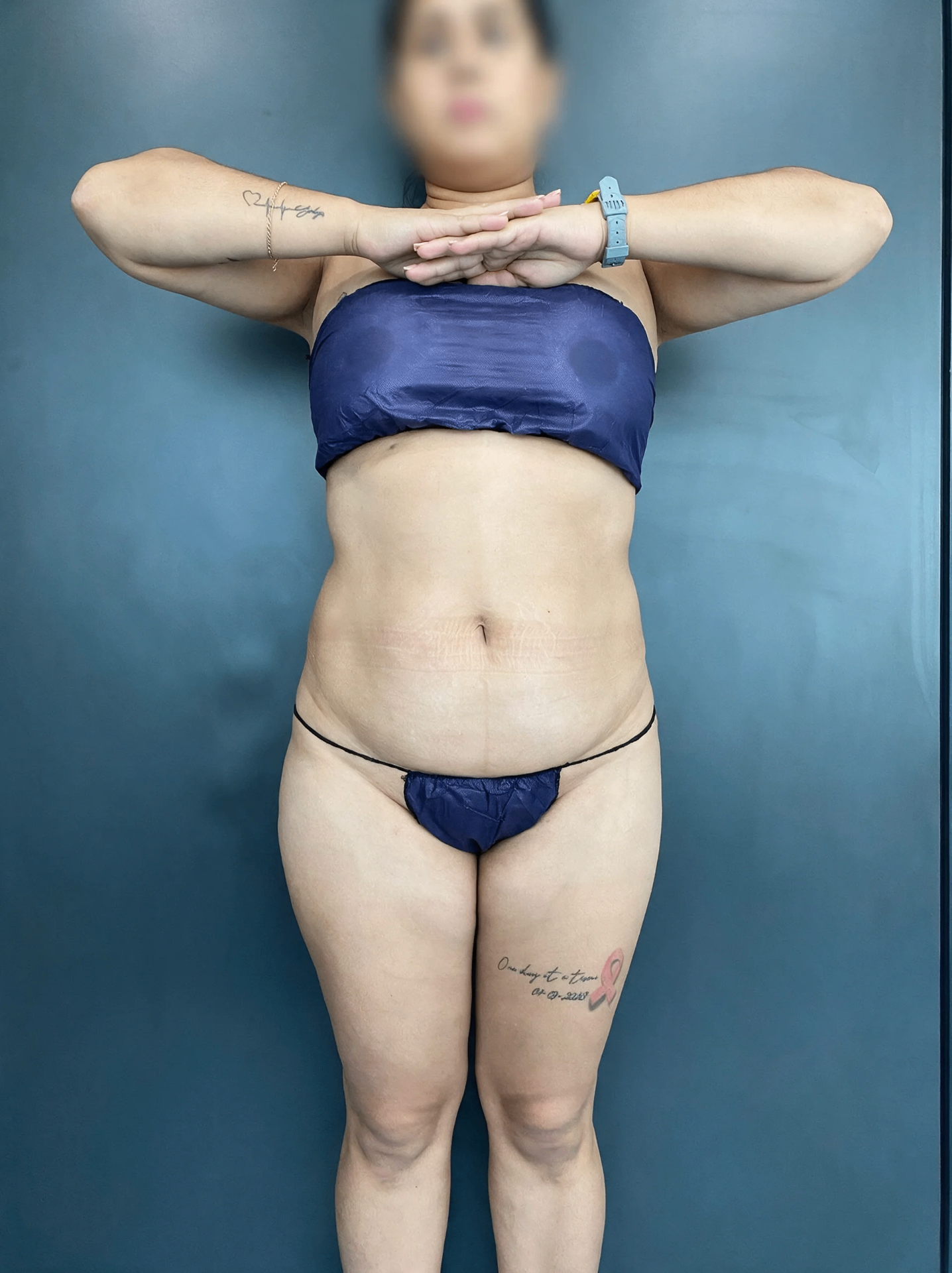 Antes — vista frontal (Lipoabdominoplastía FullTech + IGG)