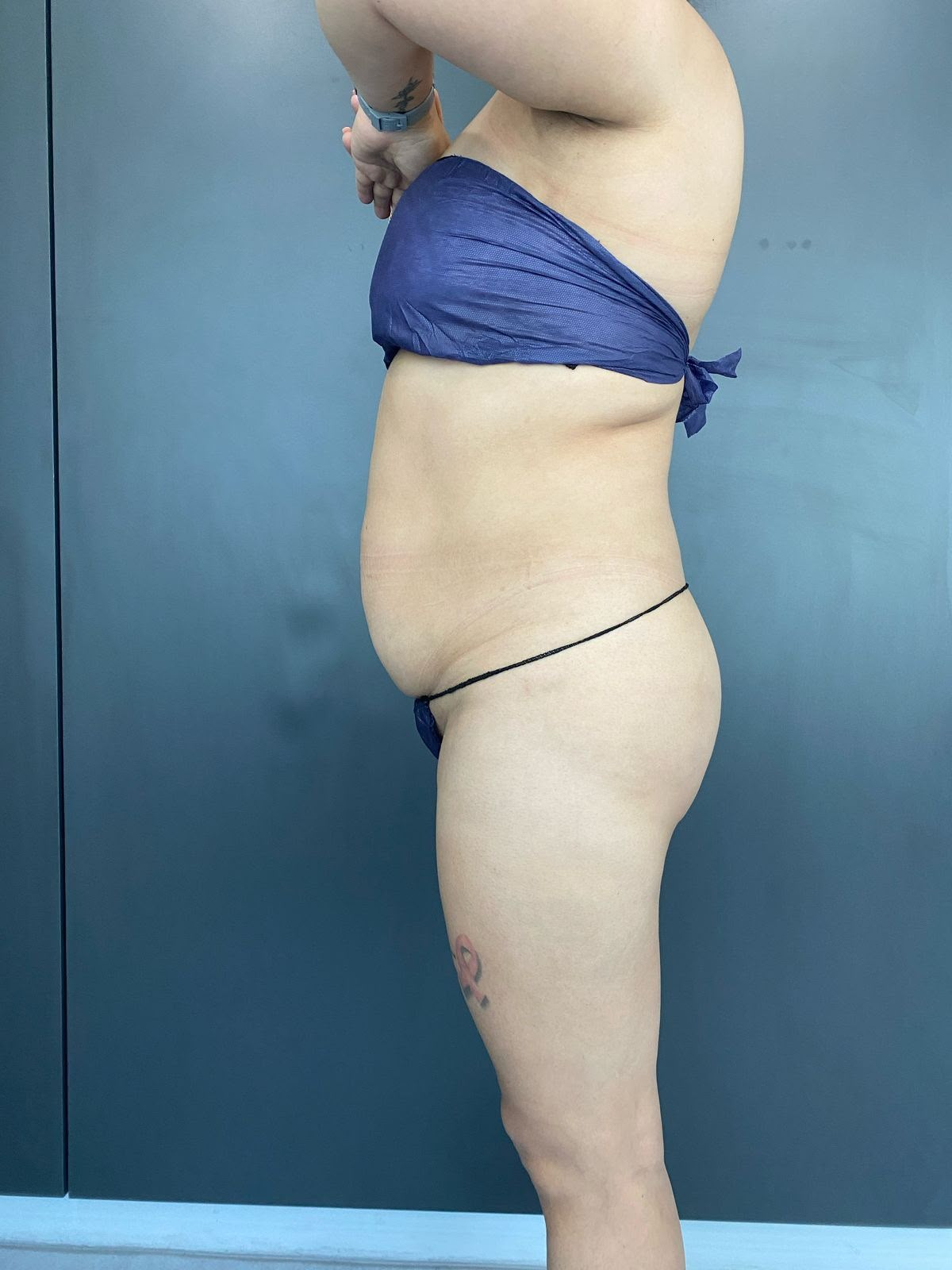 Antes — vista lateral (Lipoabdominoplastía FullTech + IGG)