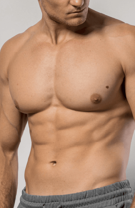 Ginecomastia — Marcación Pectoral Masculina