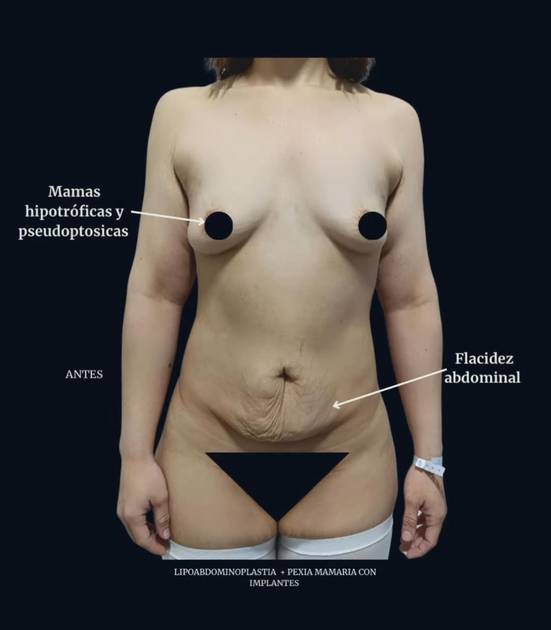 Antes de Mommy Makeover — Lipoabdominoplastía + Pexia mamaria con implantes