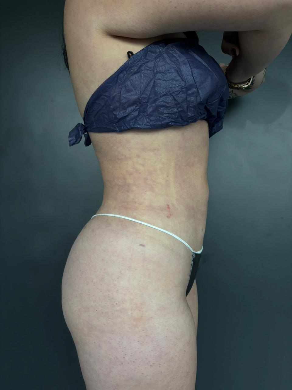 Después — Lipoescultura Hybrid 360° (perfil opuesto)