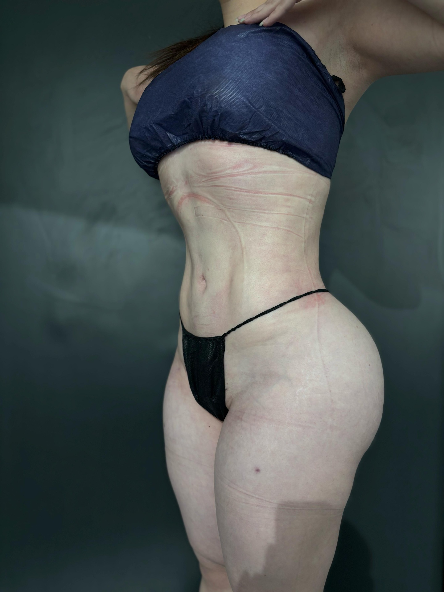 Resultado Lipoescultura FullTech — vista lateral