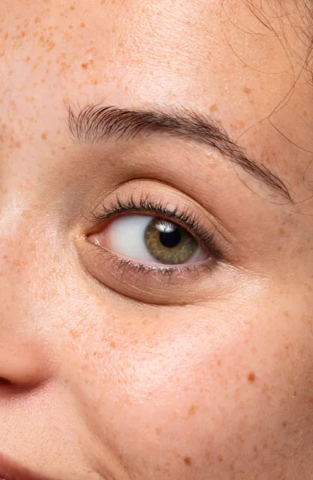 Relleno de Ojeras